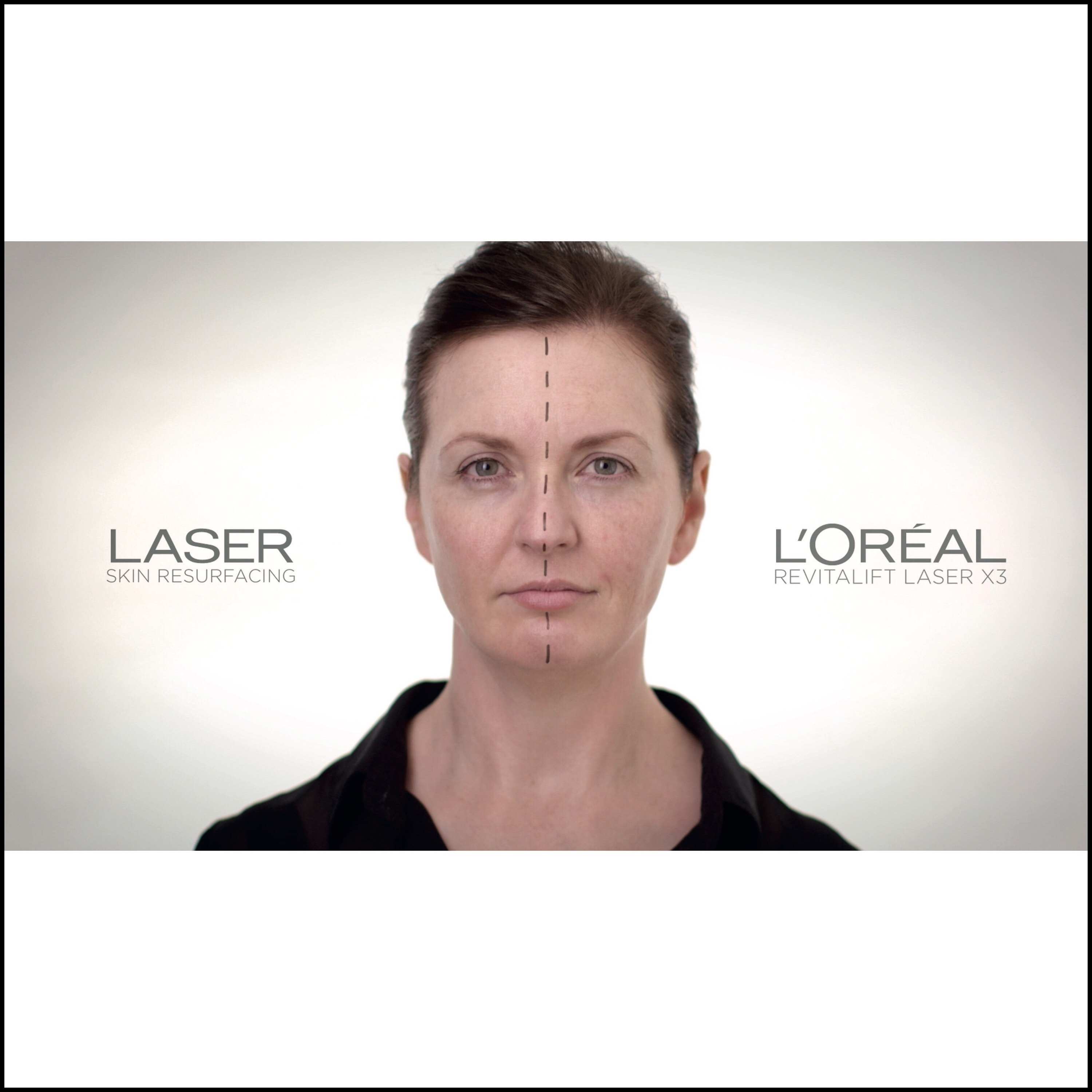Loréal vs Laser